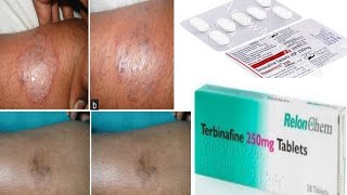 Terbinafine tablet uses and side effects full review [upl. by Josee]