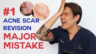 What to consider BEFORE acne scar revision Dermatologist Guide [upl. by Dnomed680]