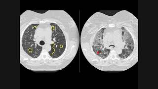 Hypersensitivity pneumonitis how to recognise on chest CT scans [upl. by Einnahc106]