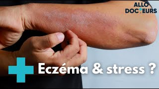 Eczéma  quelles solutions   Allo Docteurs [upl. by Iams130]