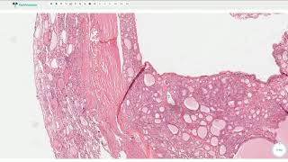 Follicular Adenoma  Thyroid Gland Histopathology [upl. by Joni]