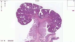 Tubular adenoma  Colon  Histopathology [upl. by Ecnerwal]