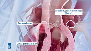 Herzklappenoperation  Medizinische Animation [upl. by Ayat29]