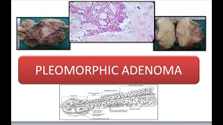 Pleomorphic Adenoma [upl. by Wivinah255]