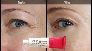 5Year RetinA Update  Before amp After for Wrinkles amp AntiAging [upl. by Arretahs]