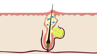 How Acne Develops  Acne Support [upl. by Neivad274]