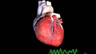 What is Ventricular Fibrillation [upl. by Einhoj]