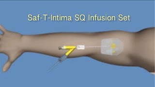 How to Insert TruSteel Infusion Set [upl. by Jarret]