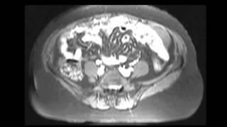 Primary peritoneal carcinomatosis [upl. by Htebazle]