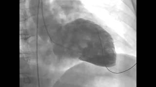 Ventricular Fibrillation during Left Ventriculography [upl. by Nadoj]