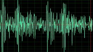 Aortic Regurgitation slow [upl. by Elmer]