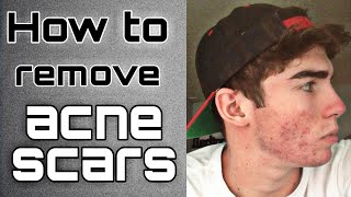 Acne Scar Removal  Methods For Removing Acne Scars [upl. by Ahsit]