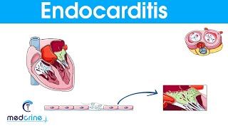 Endocarditis  causes symptoms pathophysiology diagnosis and treatment [upl. by Saimon]