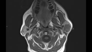 Carcinoma ex pleomorphic adenoma [upl. by Rani]