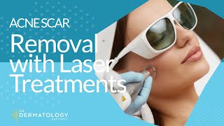 Acne Scar Removal with Laser Treatments [upl. by Florio317]