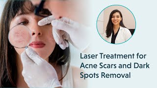 Laser Treatment for Acne Scars  Laser Treatment for Dark Spots Removal [upl. by Aonian]