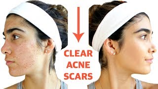 CLEAR ACNE SCARS FAST  DIY Face Masks That WORK [upl. by Seilenna160]