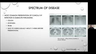 Pneumocystis jirovecii pneumonia  Current Issues in its Management [upl. by Ruon]