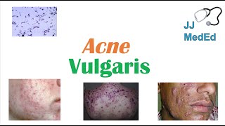 Acne Vulgaris  Causes Pathogenesis Influencing Factors Diagnosis Treatment and Complications [upl. by Runkle]