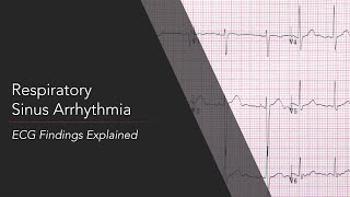 Respiratory Sinus Arrhythmia ECG [upl. by Ymassej]