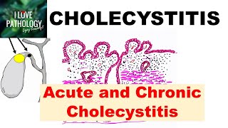 CHOLECYSTITIS Acute and Chronic Pathology and Complications [upl. by Ycnahc]