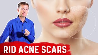 Best Way to Rid Acne Scars [upl. by Medlin]