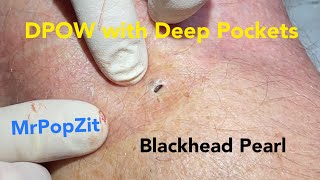 The Blackhead with deep pockets DPOW blackhead pearl extraction on posterior “popliteal” knee [upl. by Reehsab]