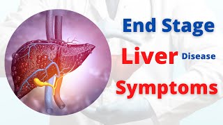 Is Liver Cirrhosis Reversible  Fibrosis vs Cirrhosis – DrBerg [upl. by Nitin290]