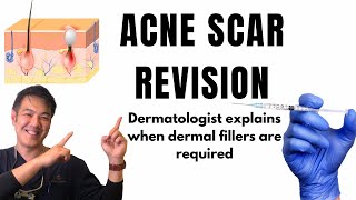 How to treat ACNE SCARS  Dermal Fillers [upl. by Hayyikaz]