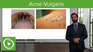 Inflammatory Skin Diseases Acne Vulgaris – Pathology  Lecturio [upl. by Nlocnil]