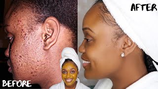 HOW TO GET RID OF ACNE SCARS AND DARK MARKS FAST  DIY TURMERIC HONEY LEMON AND ALOE FACE MASK [upl. by Scrogan]