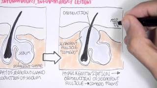 Acne Pathophsyiology [upl. by Devonna]