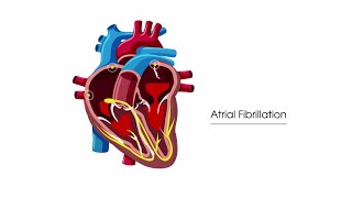 What is atrial fibrillation [upl. by Carling]