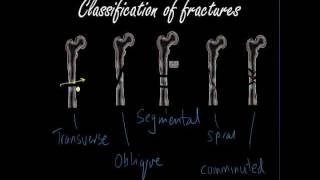 Classifying and presenting Fractures  Orthopaedics for Medical Students  Finals [upl. by Nikkie]