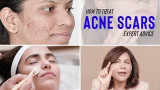 How to Prevent and Treat Acne Scars [upl. by Eidnyl994]