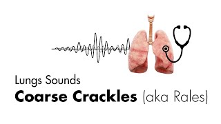 Coarse Crackles Rales  Lung Sounds  Medzcool [upl. by Anauj]