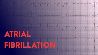 Atrial Fibrillation Afib  EKG ECG Interpretation [upl. by Lerud]