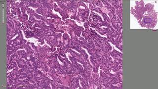 Endometrial Adenocarcinoma  Histopathology [upl. by Iegres]