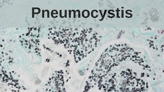 Pneumocystis Pneumonia  Pathology mini tutorial [upl. by Dwain]