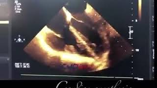 Ventricular fibrillation under ULTRASOUND [upl. by Akyre599]