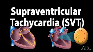 Supraventricular Tachycardia SVT PSVT Animation [upl. by Monia]