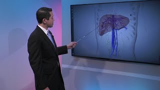 Liver Cancer Staging [upl. by Atteuqehs]