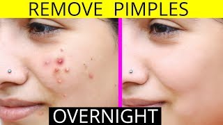 How To Remove Pimples Overnight  Acne Treatment  Anaysa [upl. by Ymarej]