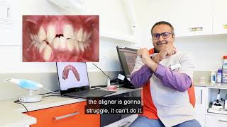 Who is not suitable for clear aligners [upl. by Allveta]