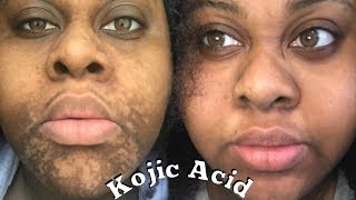 4 MONTHS KOJIC ACID EXPERIENCE \\ Sherelle Saint Rose [upl. by Socha666]