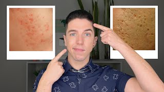 How to Get Rid of Acne Scars [upl. by Fotinas808]