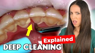 Dental Hygienist Explains Deep Cleaning Procedure [upl. by Anelej]