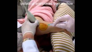 UltrasoundGuided Glenohumeral Joint Injection [upl. by Eanrahs]