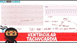 Rate and Rhythm  Ventricular Tachycardia [upl. by Ttevy]