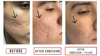 Subcision  Filler for Acne Scars [upl. by Ihtak]